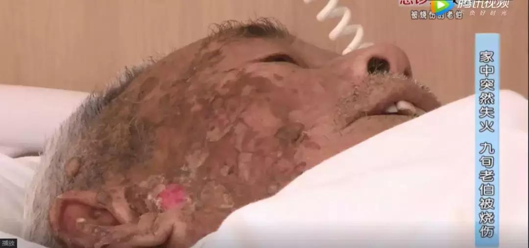 苏州科技城医院烧伤整形科｜谨防烧烫伤，变成一个更美好的你