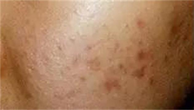 为什么痘印祛不了,为什么痘印去除不了