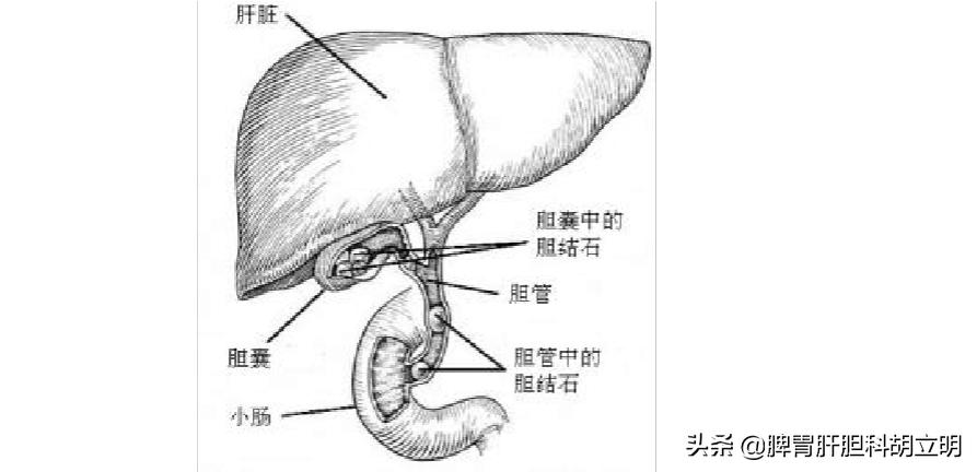 慢性胆囊炎是怎么引起的,慢性胆囊炎都是由什么引起的