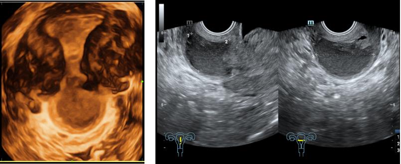 病例分析室|NO.45“特殊”青春期异常子宫出血一例病案分析