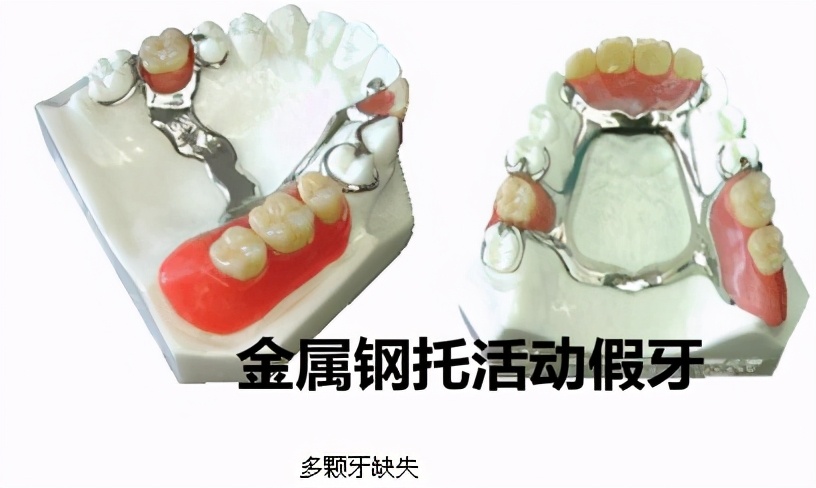 牙科讲课课件,口腔义齿知识大全