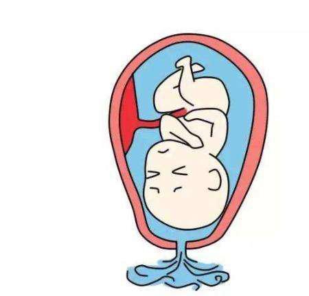 破水后还在流羊水,破水了羊水会流光吗