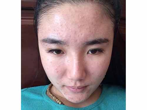 闭口黑头粉刺怎么才能根除,有效解决黑头闭口粉刺的问题