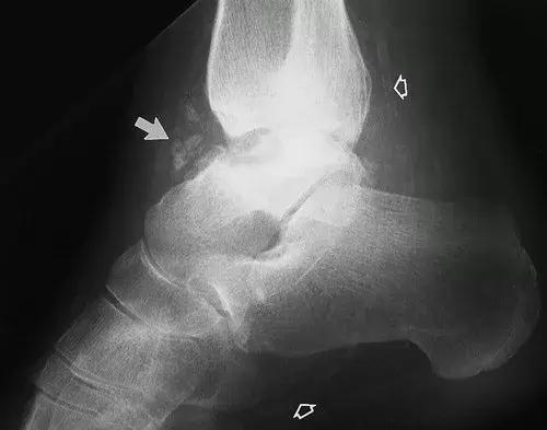 神经性骨关节病,神经性关节炎症状图片