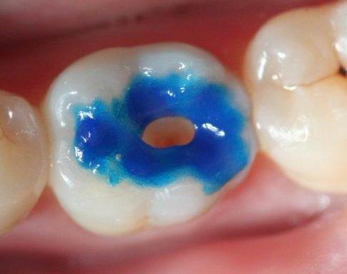 牙齿总是酸痛怎么解决,牙齿总是酸痛是什么原因造成的