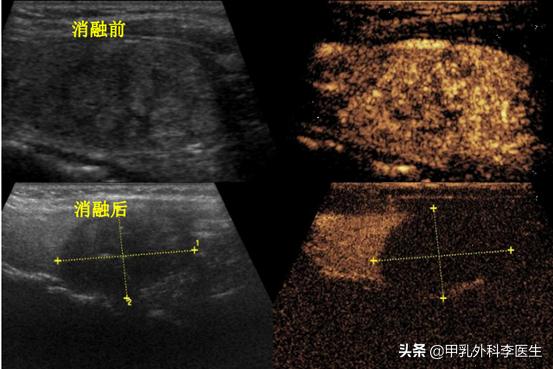 消融术治疗甲状腺结节要多久能好,甲状腺开刀还是消融术