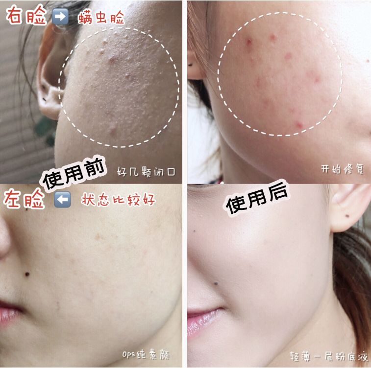 脸油痘痘多黑头用什么简单洗干净,清理黑头痘痘的最简单方法