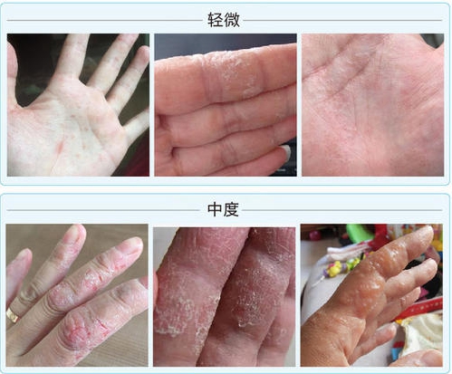 一到春夏手脚就有水泡怎么搞,一到夏天手脚上就起小水泡特别痒