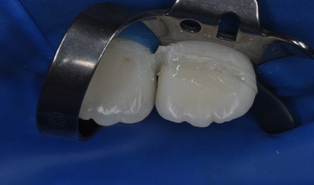 牙拔掉后扔掉还是留着,牙折断还能接回去吗