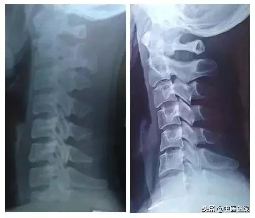 北京中医医院马彦旭主任:你的颈椎变直了么?别怕,中医有办法!