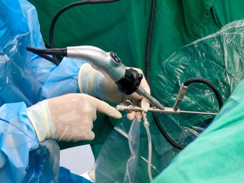 什么是微创手术通俗解释,腋臭微创手术