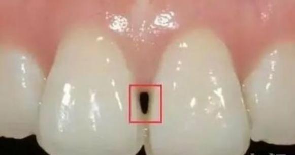 为什么牙齿黑三角不可逆,黑三角是不可逆的吗