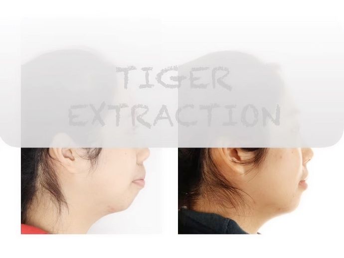 牙齿矫正南京哪家医院比较好,牙齿代偿性矫正