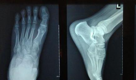 打篮球崴脚脱鞋捏脚,打篮球怎么避免崴脚