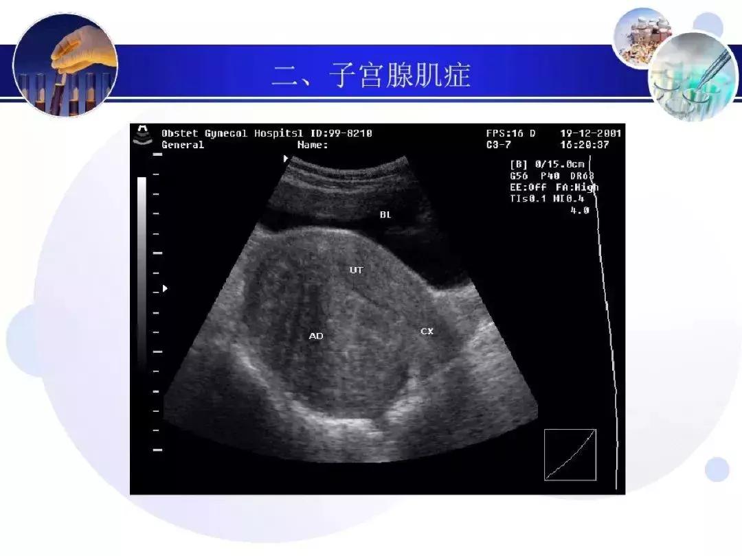 纯干货！子宫及附件解剖和超声诊断