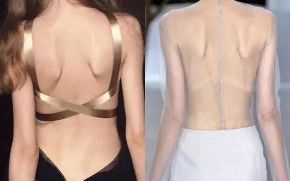 蝴蝶骨最好的矫正方法,蝴蝶骨是不良体态吗