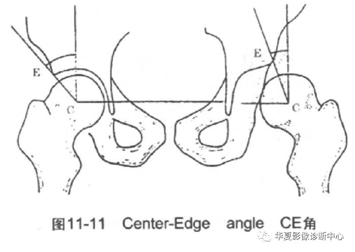 先天性髋关节脱位截骨术全过程,先天性髋关节脱位可以考驾驶证吗