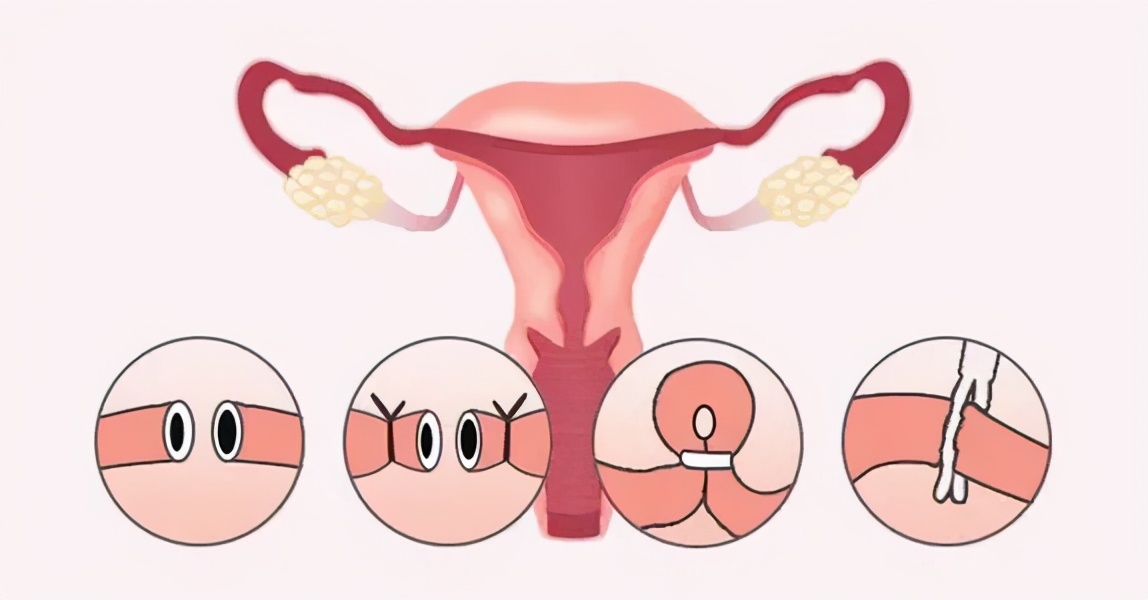什么是输卵管复通,做了输卵管复通术可以怀孕几次