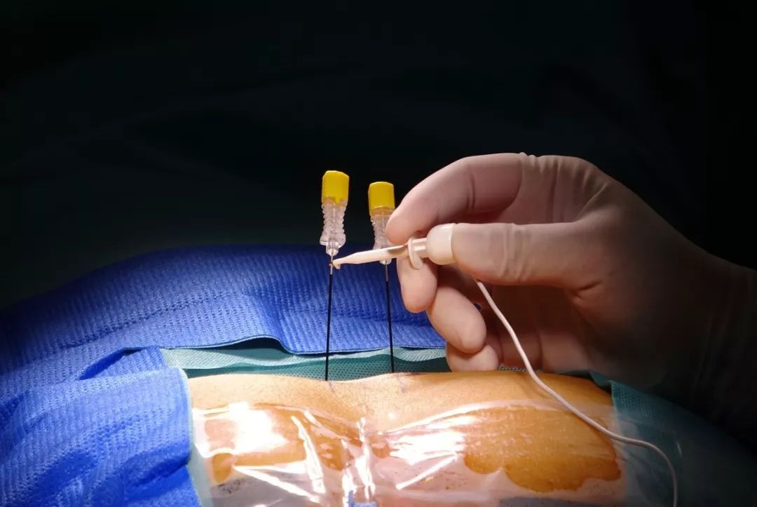 坐骨神经痛是糖尿病引起的吗,被糖尿病并发症吓到