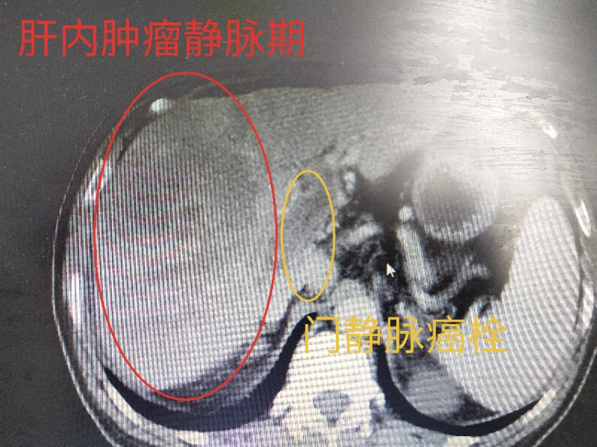 输血得肝炎,输血感染丙肝能自愈吗