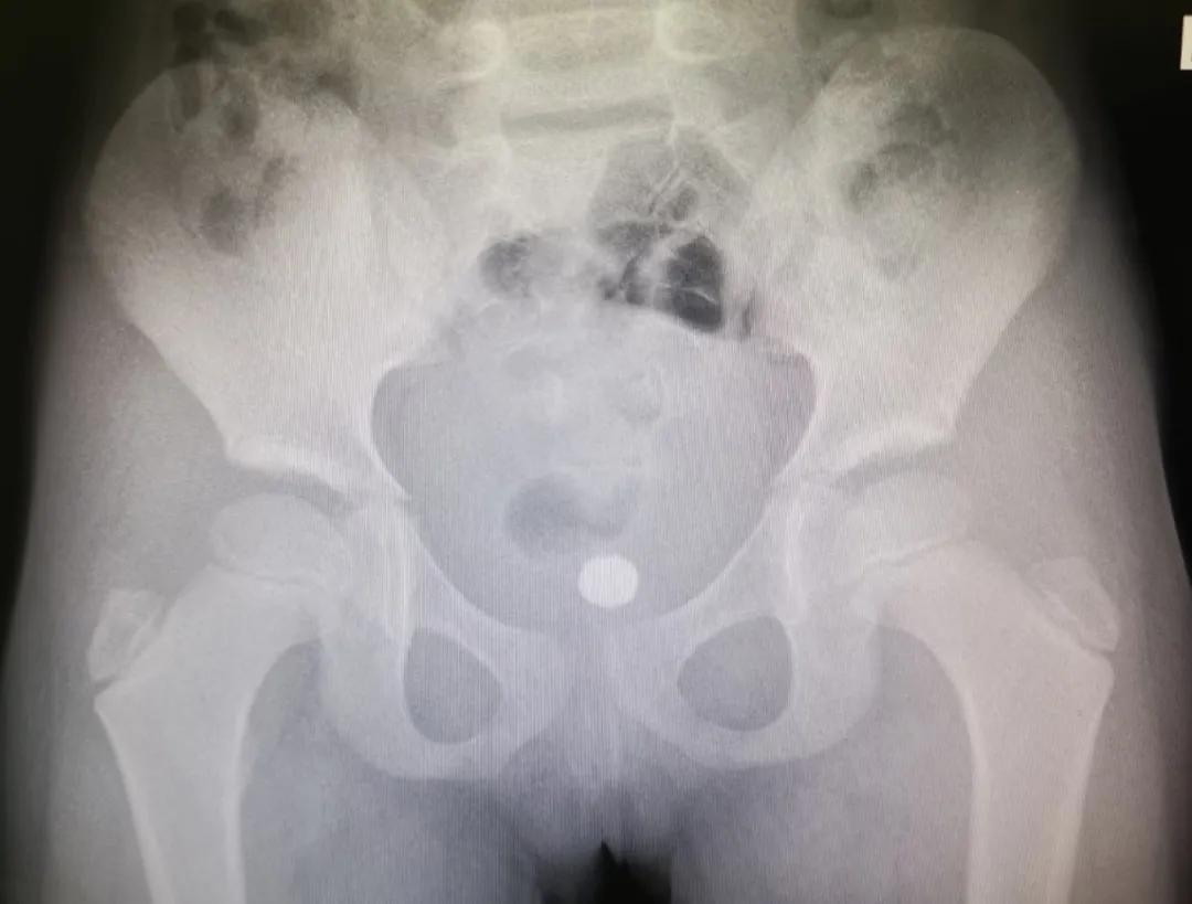 四岁小男孩往小丁丁里塞弹珠？那些年孩子塞进去的东西远不止这个