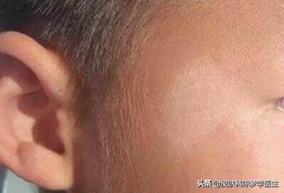 如何鉴别皮肤白斑是否是白癜风,皮肤长白斑用什么药膏