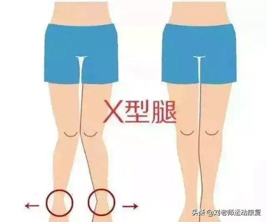感觉腿不直？这种腿型还会导致膝盖疼，“X型”腿完整康复方案