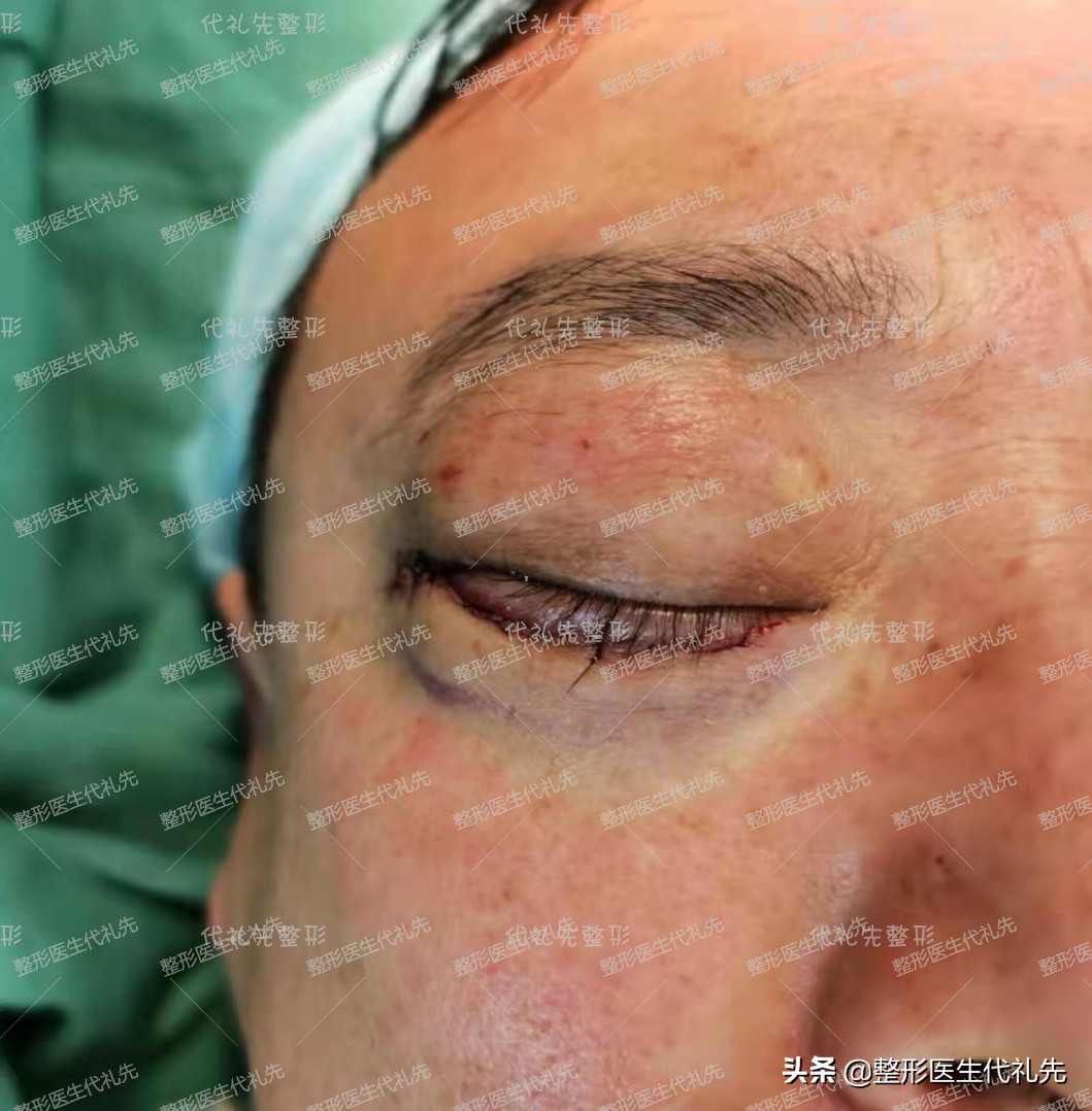 眼周年轻化手术图片,眼周年轻化什么项目