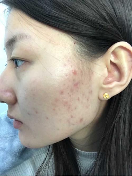 痘印一直不消了怎么办,痘印几年都消不了怎么办