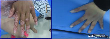 肢端型白癜风能彻底治愈吗,肢端型白癜风的治疗重点有哪些