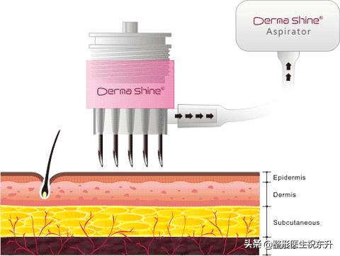 一次水光等于1000张面膜是真的吗,打水光针有副作用吗有依赖性吗