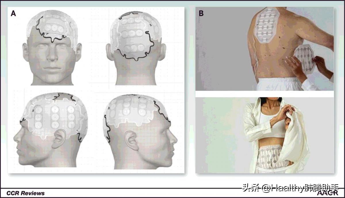 新来的，靠谱吗？肿瘤电场治疗仪即将进入中国大陆市场