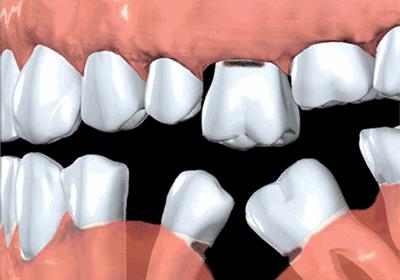 女子缺牙三年不补,女性缺牙3年不补