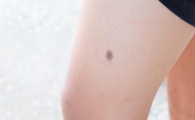 黑色素痣恶化为黑色素瘤的前兆,黑色素瘤会不会危及生命