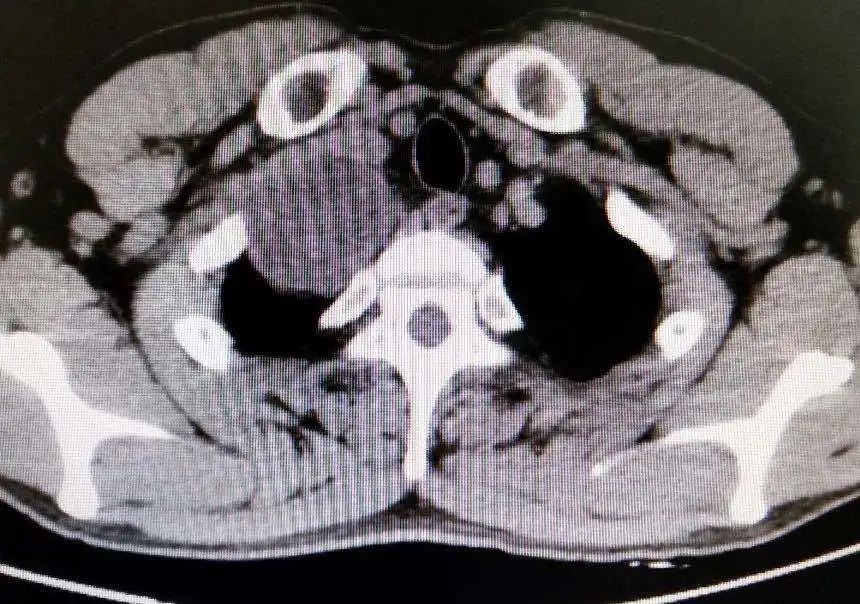 26岁小伙子查出恶性肿瘤,27岁小伙突然发现恶性肿瘤