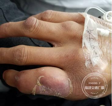 男子身上长出了石头,全身长石头后来怎么样了