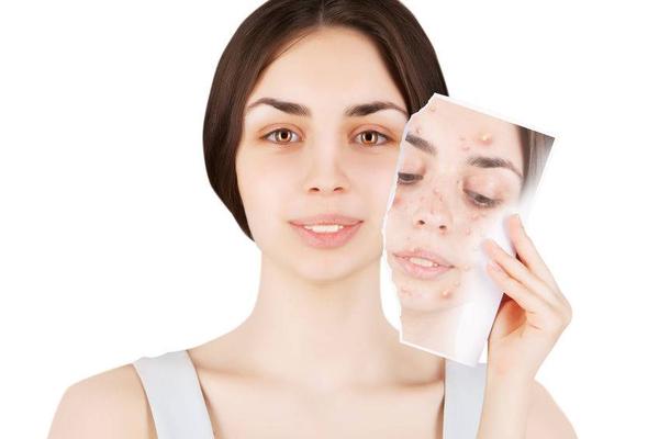 红痘印和黑痘印一起怎么去除,脸上有红痘印和黑痘印