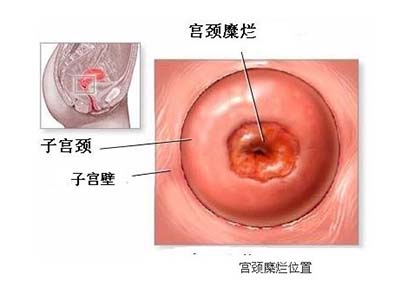 宫颈糜烂要不要治疗一文说清楚,宫颈糜烂10分钟红光治疗危害