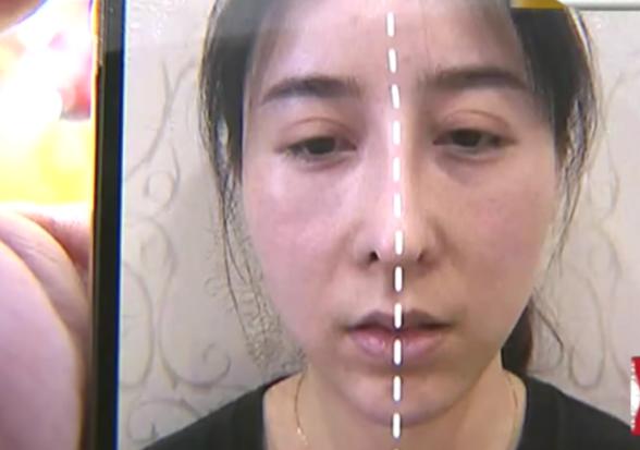 隆鼻几年发现鼻子有点歪,隆鼻鼻子做歪了怎么办