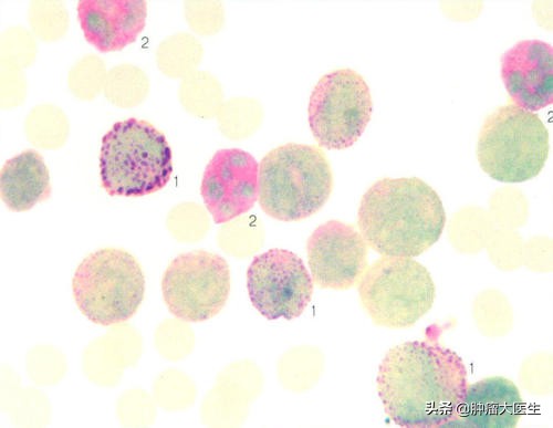 6项肿瘤标志物检测竟能查出数十种问题