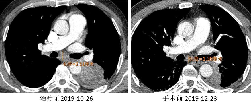 PD-1新辅助治疗初探，典型案例汇总一览