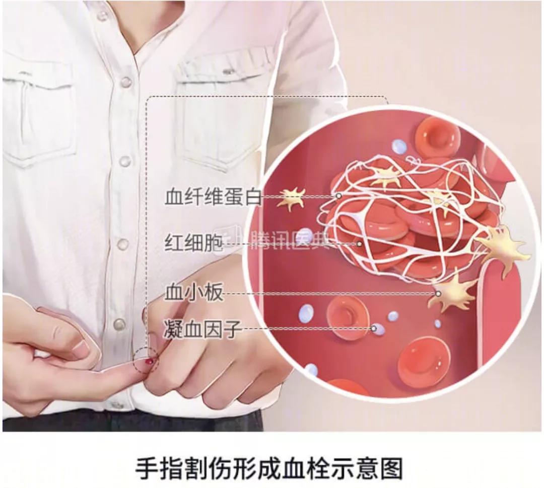 深静脉血栓的治疗方法,什么是下肢深动脉血栓