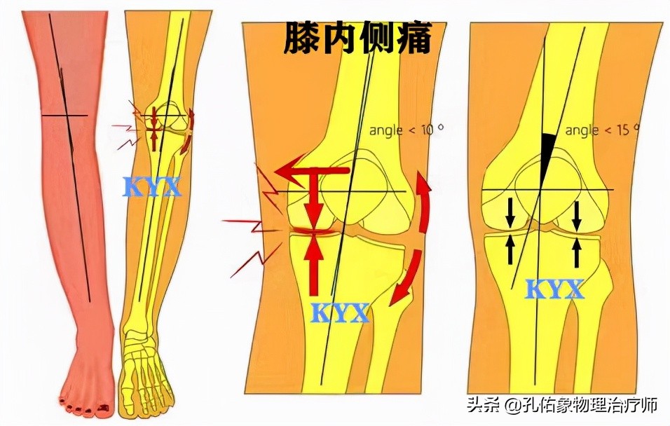 膝关节水肿痛有积液最佳治疗方法,膝关节肿胀形成积液原因