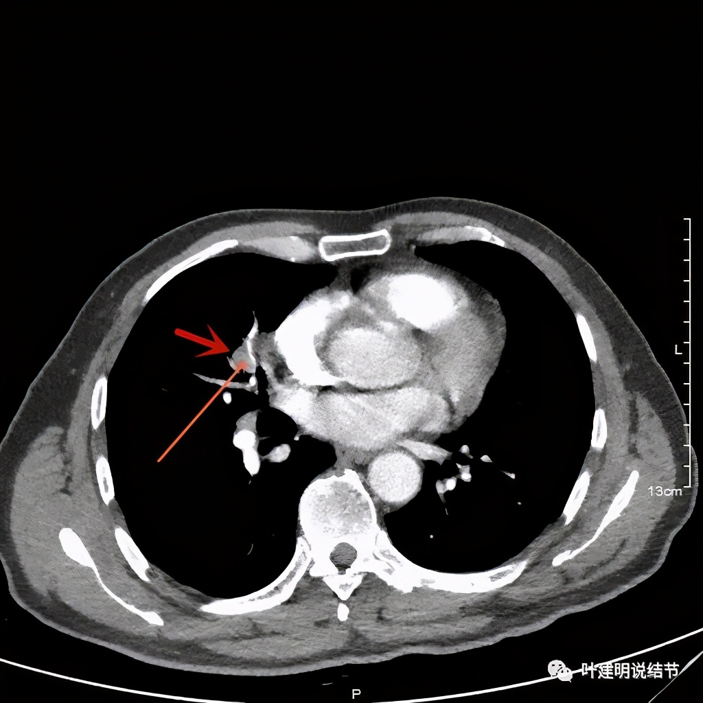 实性结节影要不要紧,实性结节穿刺活检为良性