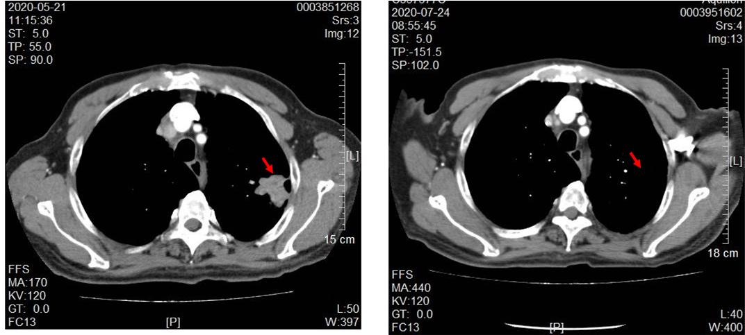78岁肺癌晚期老人能用靶向药吗,食道癌通过化疗肿瘤消失成功案例