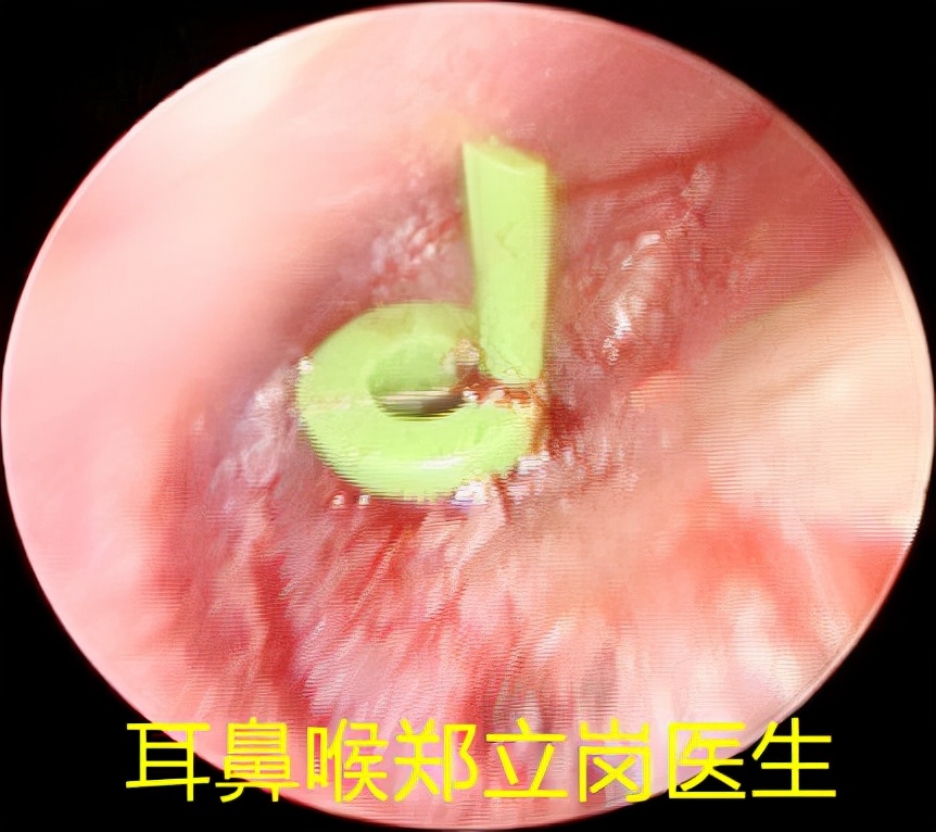 儿童中耳炎乳突炎怎么治疗,孩子7岁得了中耳乳突炎