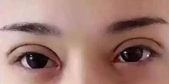 怎样修复双眼皮线条,上海修复肉条双眼皮哪里做的好