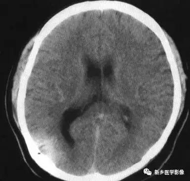 脑室为什么会扩张,脑室为什么会变小