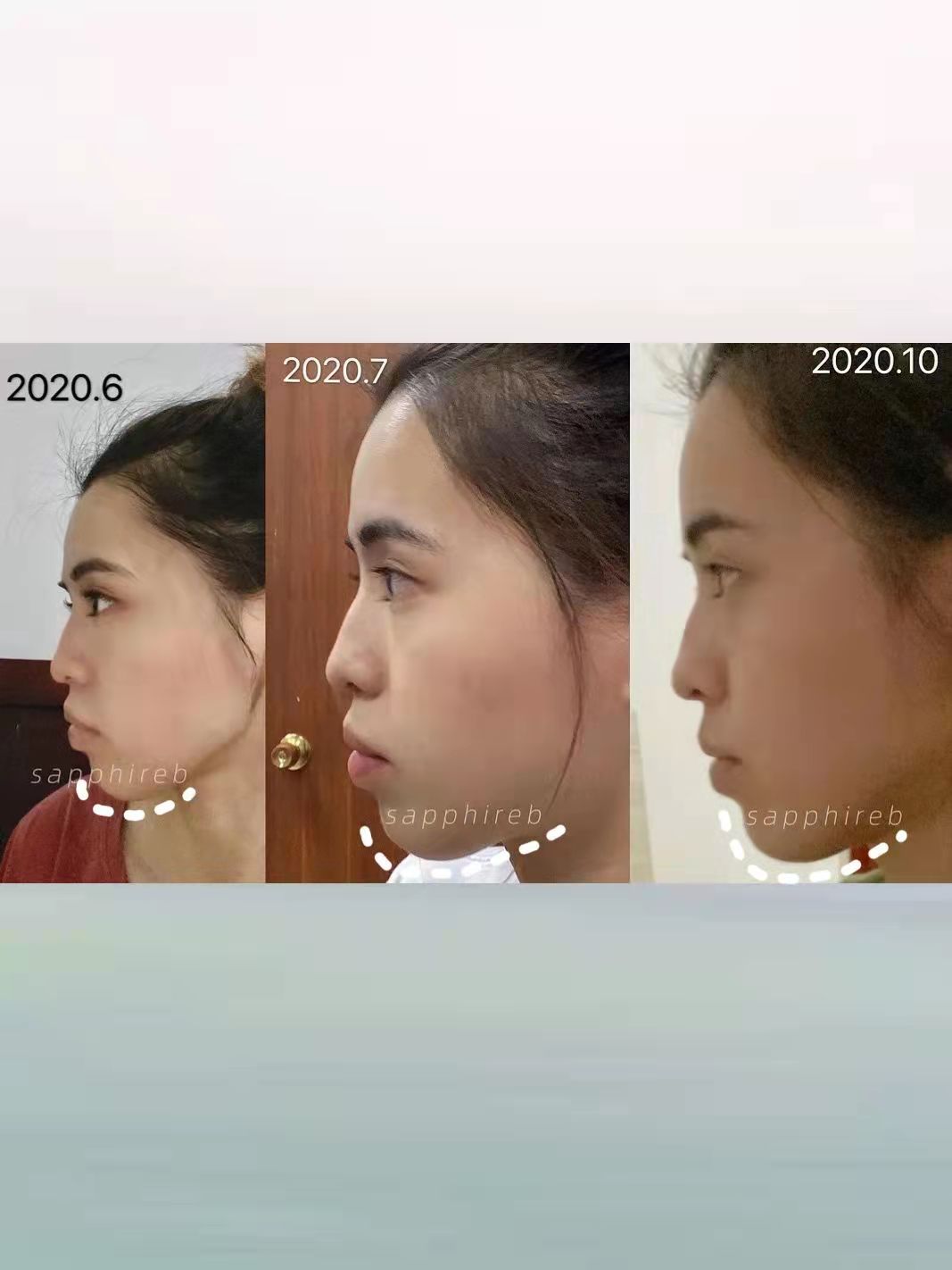 整牙分享,分享自己整牙过程怎么赚钱