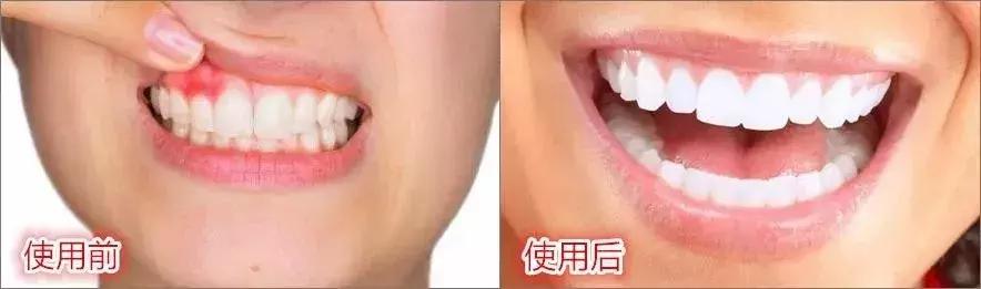 一口黄牙竟让形象尽毁！‘到手香’帮你重新找回自信！大胆开笑